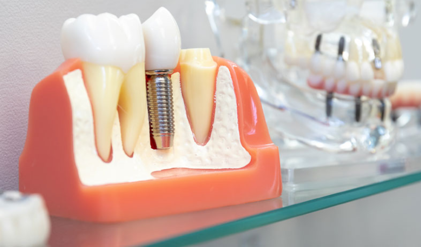 6 Things To Consider When Choosing Dental Implant Dentist
