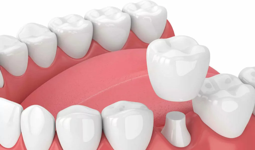 5 Important Facts To Know About Dental Crowns