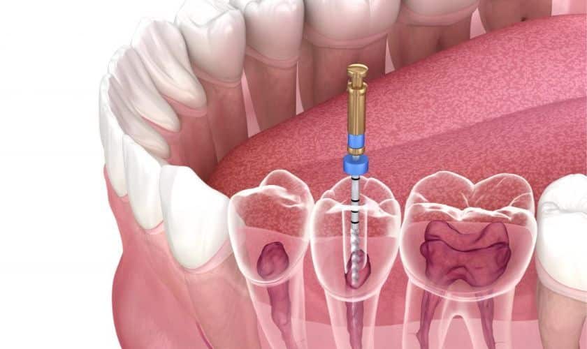 Root Canal 101: A Comprehensive Overview of the Treatment
