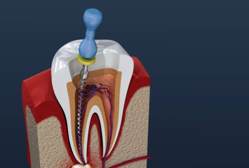 Smile Saver: How Root Canal Treatment Rescues Damaged Teeth