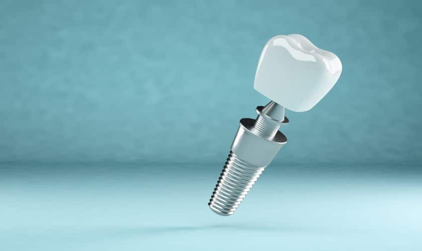 The Role of 3D Dental Imaging in Accessible Implant Dentistry