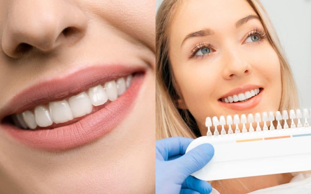 Teeth Whitening vs. Veneers